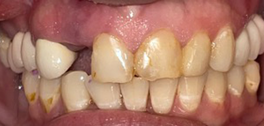 Smile with damaged and missing teeth