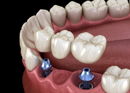 Animated dental implant supported fixed bridge placement