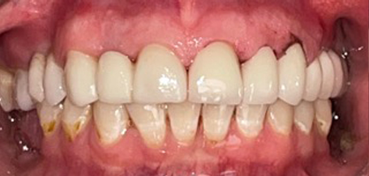 Smile with repaired and replaced teeth