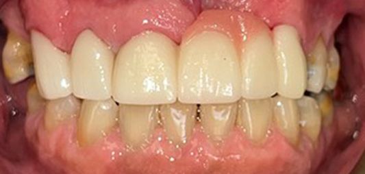 SMile with aligned and replaced teeth