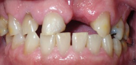 Smile with missing and misaligned teeth