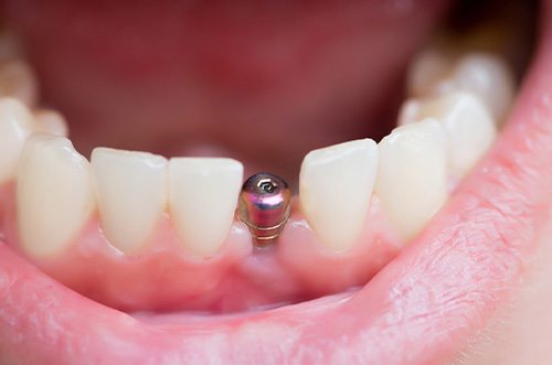 A closeup of a single tooth implant’s abutment