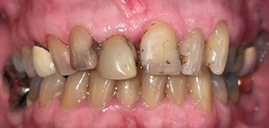 Severe tooth decay and damaged present before smile is repaired