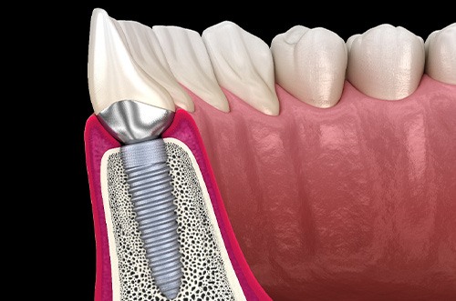 A 3D illustration of a dental implant and its crown