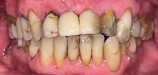 Severely damaged smile before dental treatment