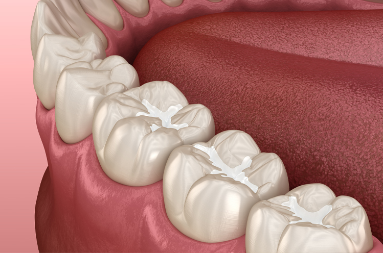 Animated smile with dental sealants