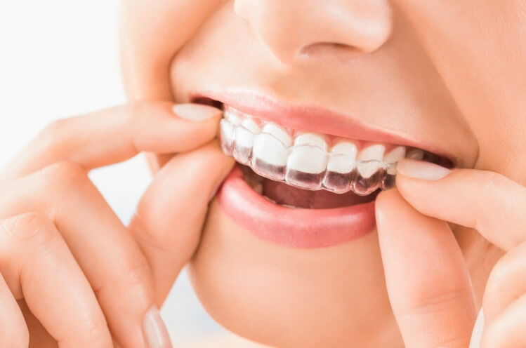 Closeup of dental patient placing an Invisalign clear braces tray