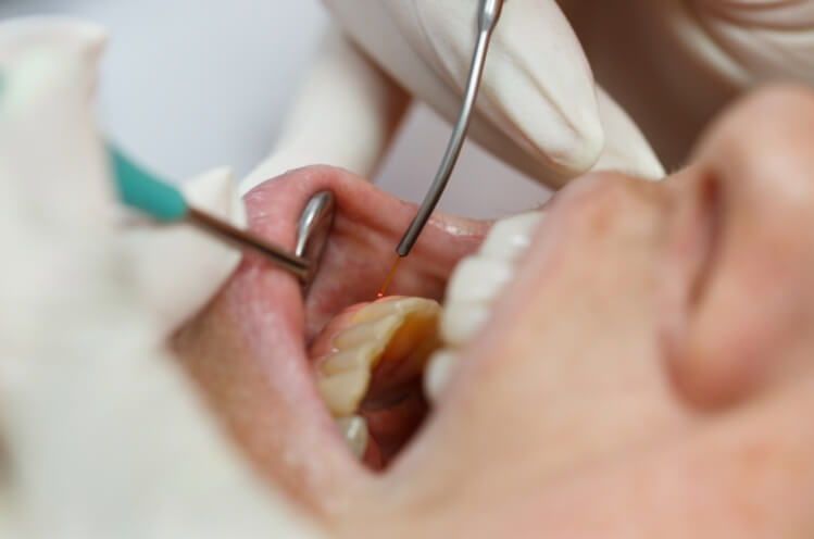 Dental patient receiving soft tissue laser dentistry