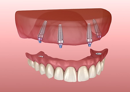 Implant-supported upper denture