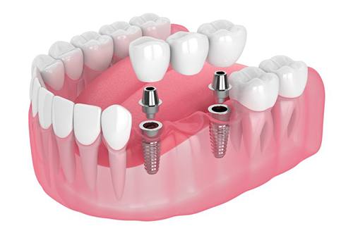 Exploded illustration of dental bridge with implants