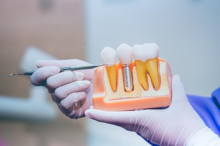 Dentist pointing at model dental implant supported dental crown