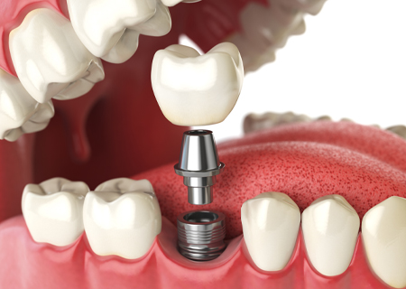 Animated dental implant supported dental crown placement