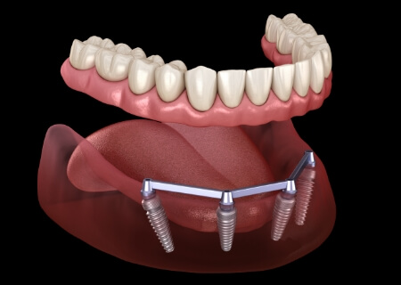 Animated dental implant supported denture placement