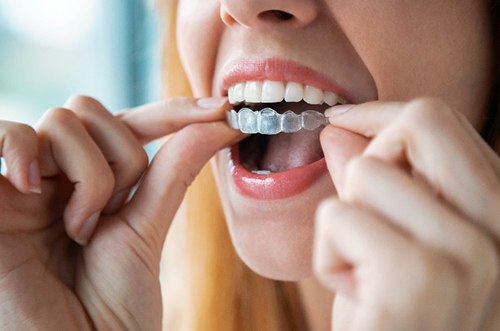 Closeup of patient placing clear aligners in their mouth