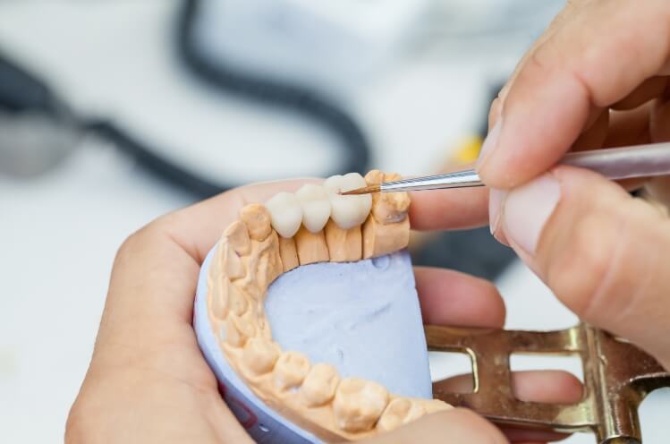 Smile model with a dental crown supported fixed bridge restoration