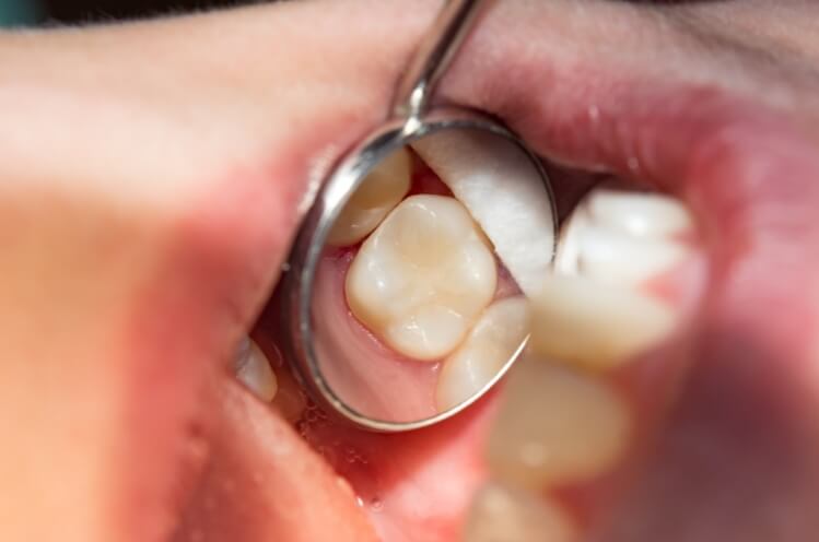 Dentist examining smile after tooth colored filling