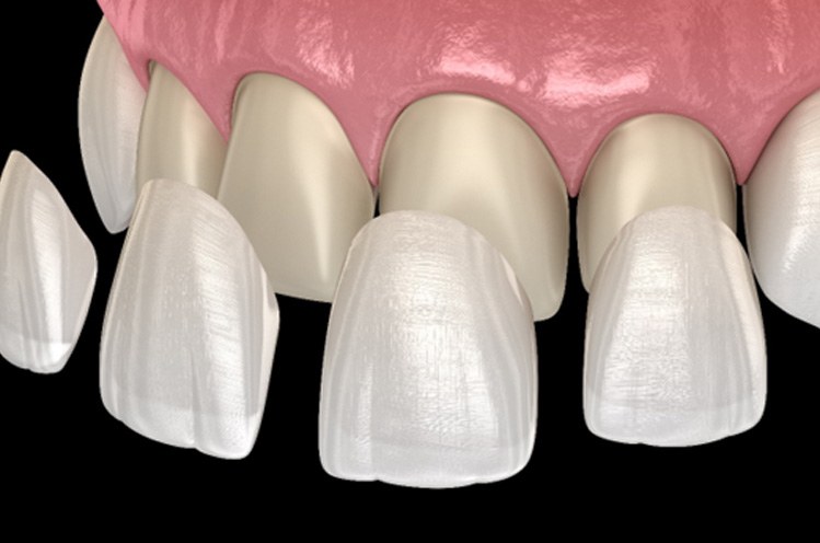 3D illustration veneers in East Gwillimbury